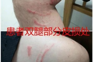 男人野外撮虾子招来飞虫一顿狂拍之后埋下祸源